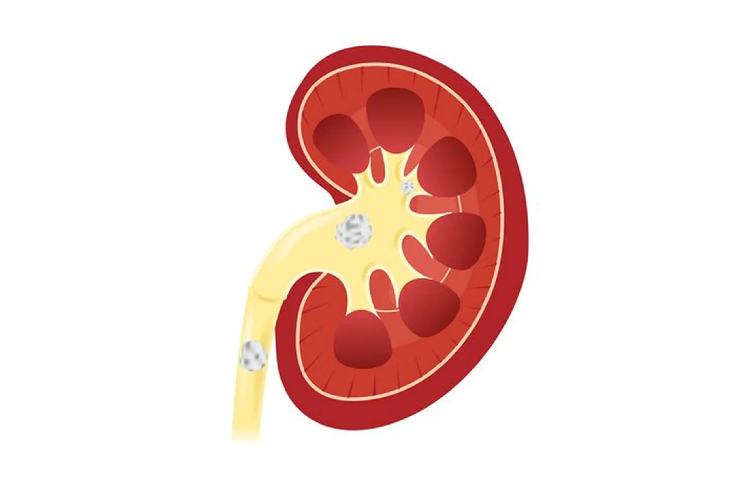Kidney Stones Treatment