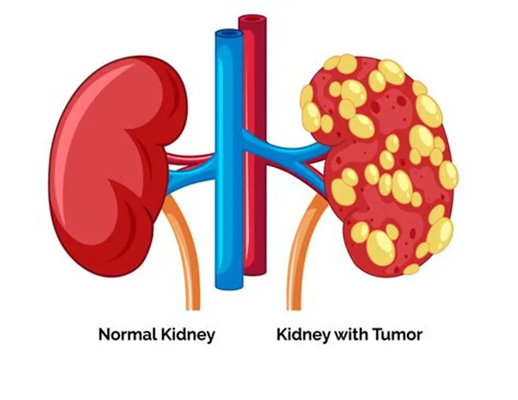Kidney Tumors Management