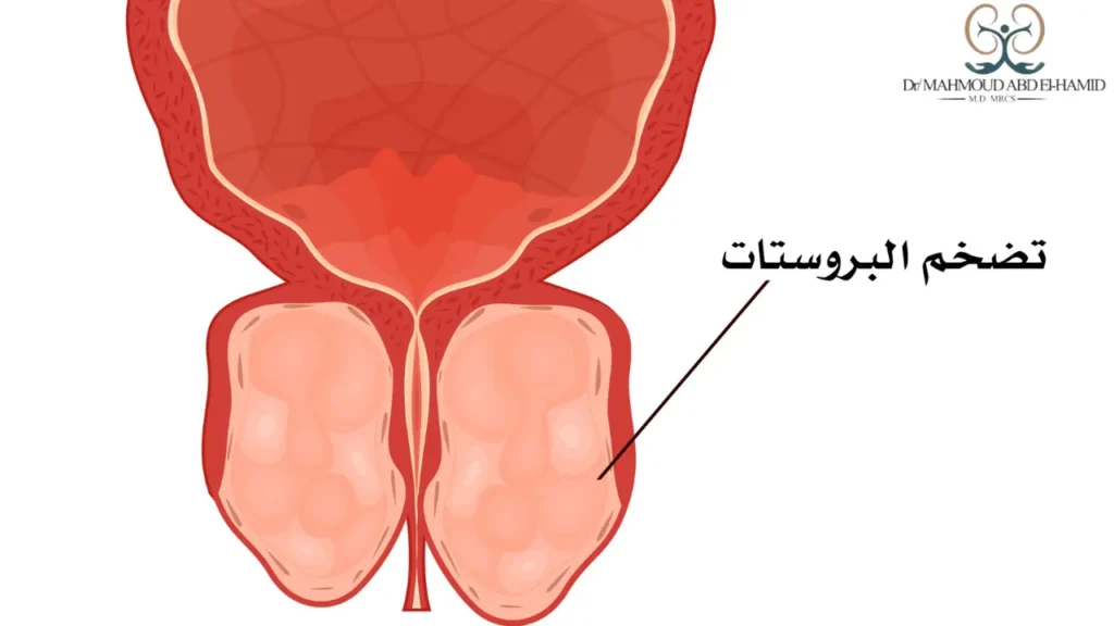 متى يكون تضخم البروستاتا خطير؟