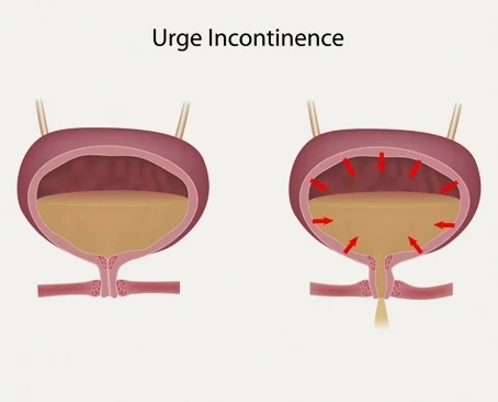Involuntary Urination