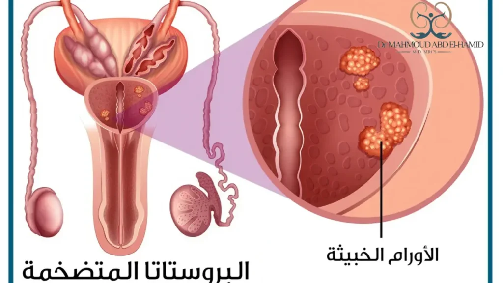 هل يمكن الشفاء من سرطان البروستاتا​؟ - د.محمود عبد الحميد