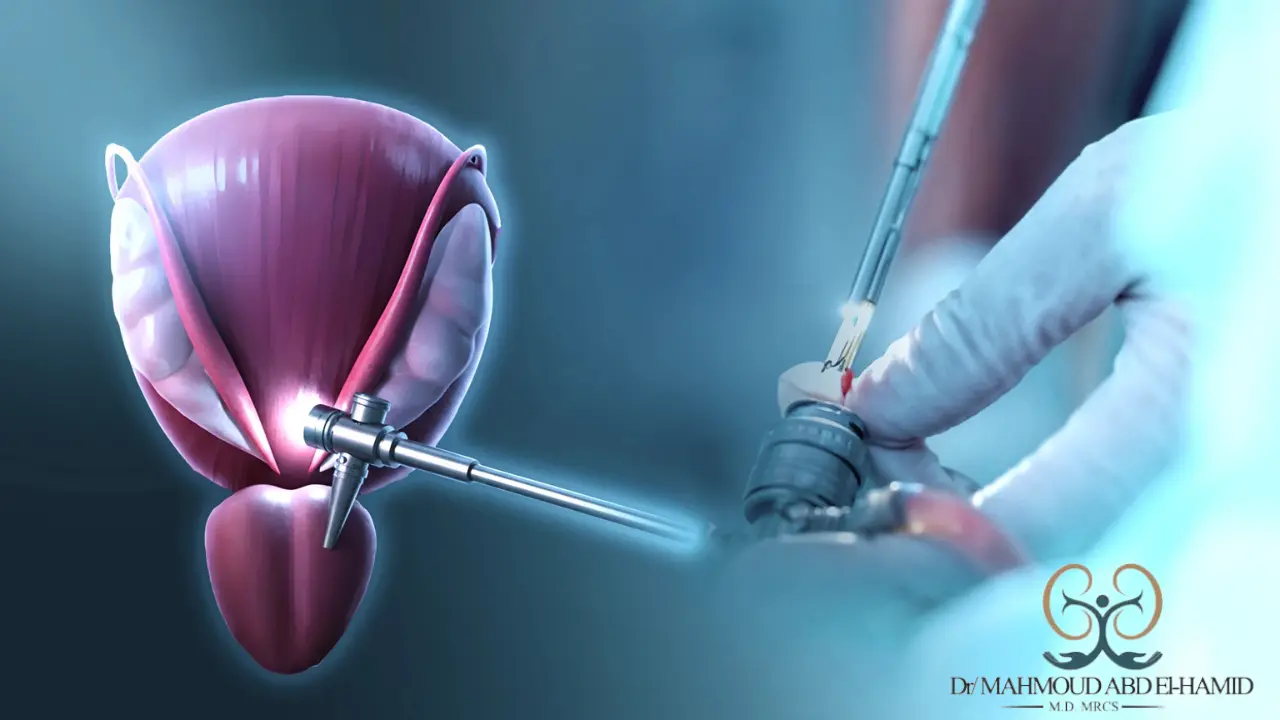 استئصال البروستاتا عبر الإحليل (TURP) - الدليل الشامل للعملية ومدة الشفاء والتكلفة في مصر- د. محمود عبدالحميد